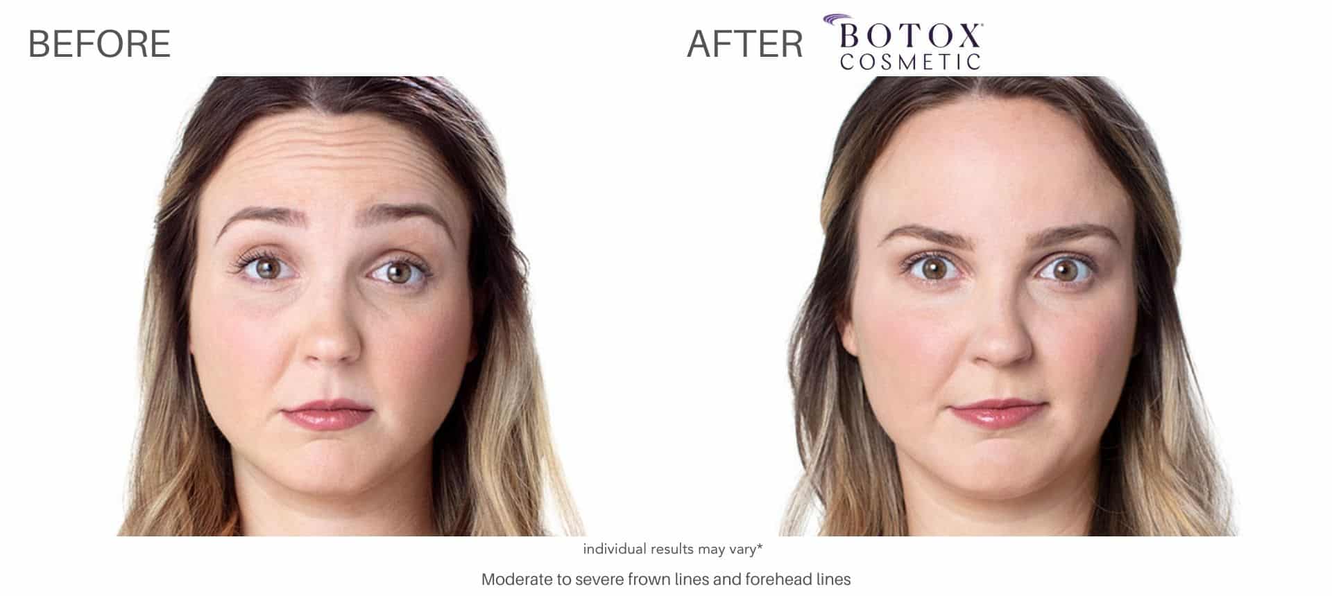 Woman's before and after picture from Botox