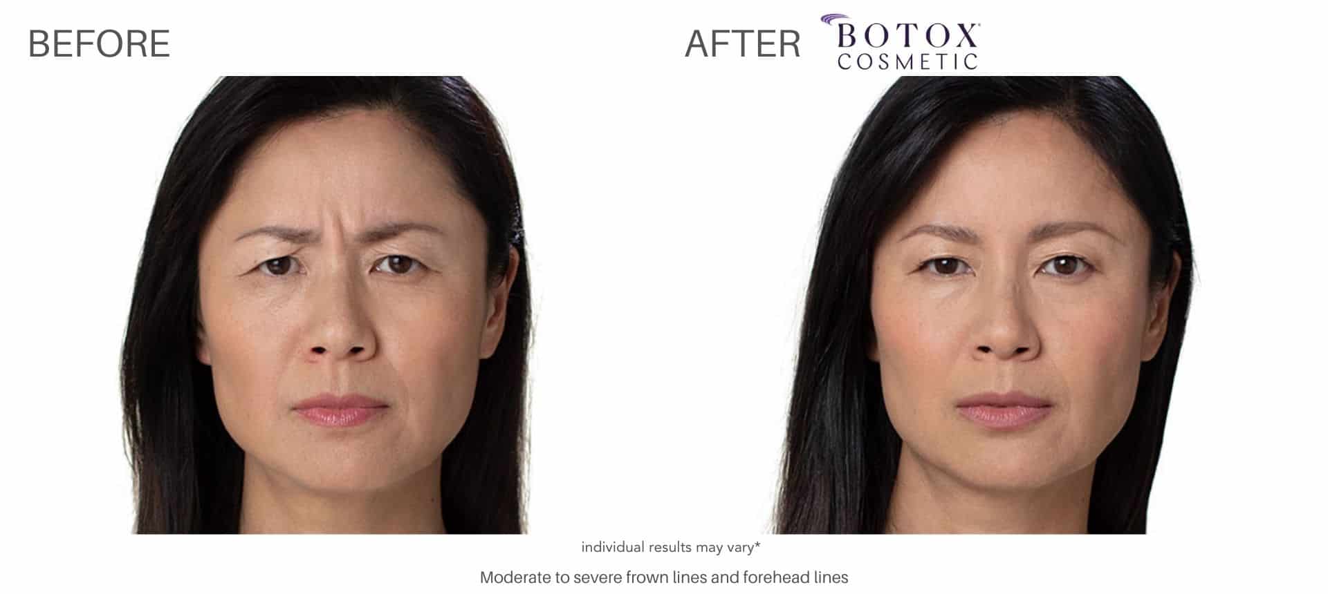 Woman's before and after pictures from botox
