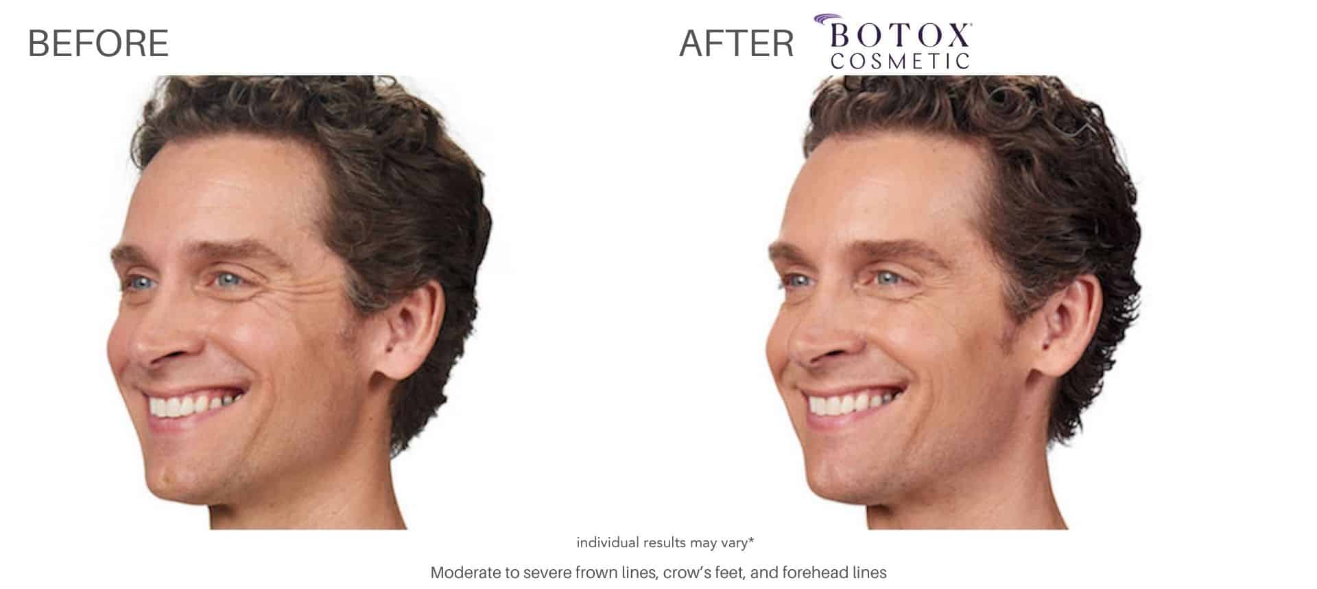 Man's before and after pictures from botox