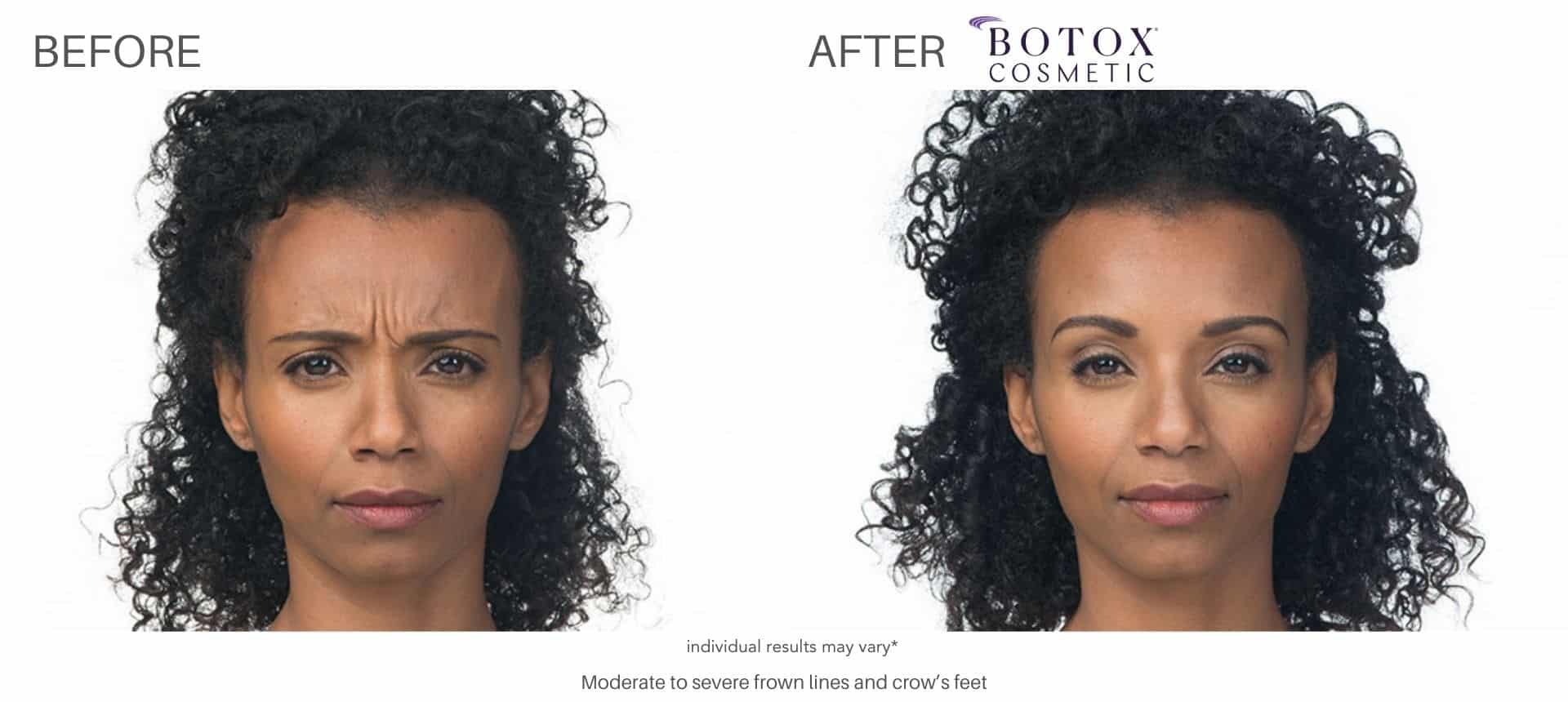 Woman's before and after pictures from botox