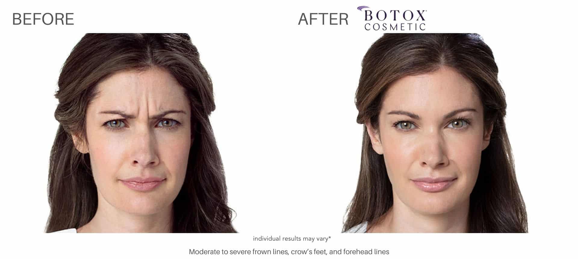 Woman's before and after photos from botox