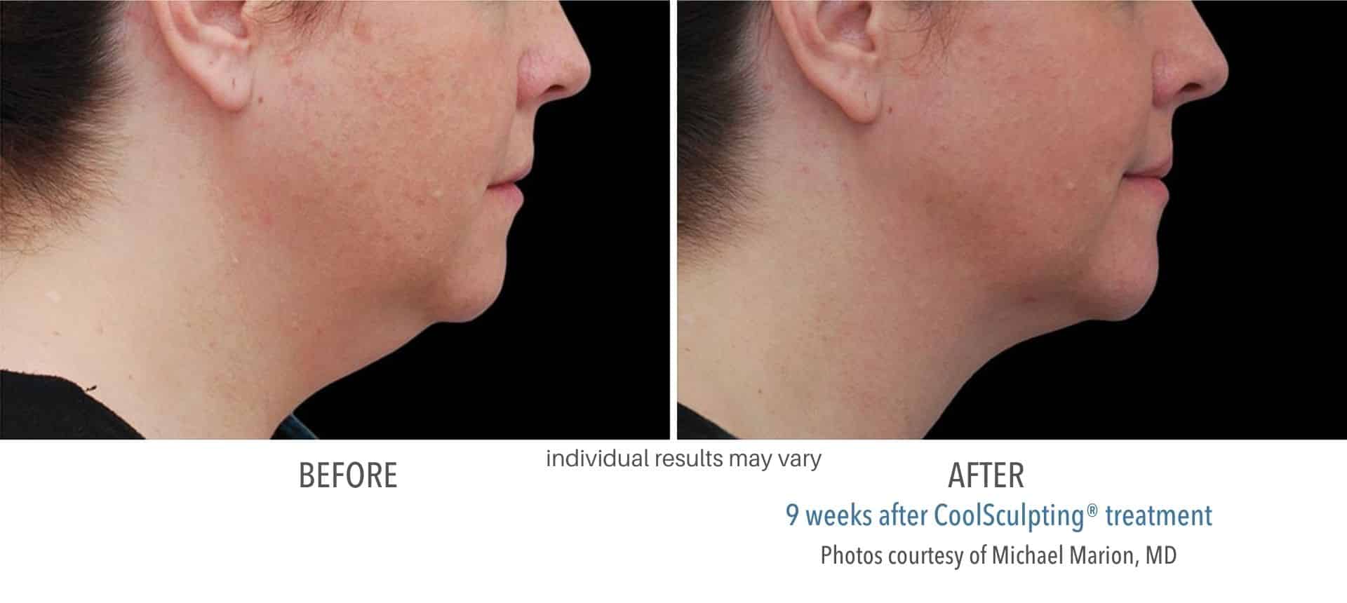 Coolsculpting chin before and after results.