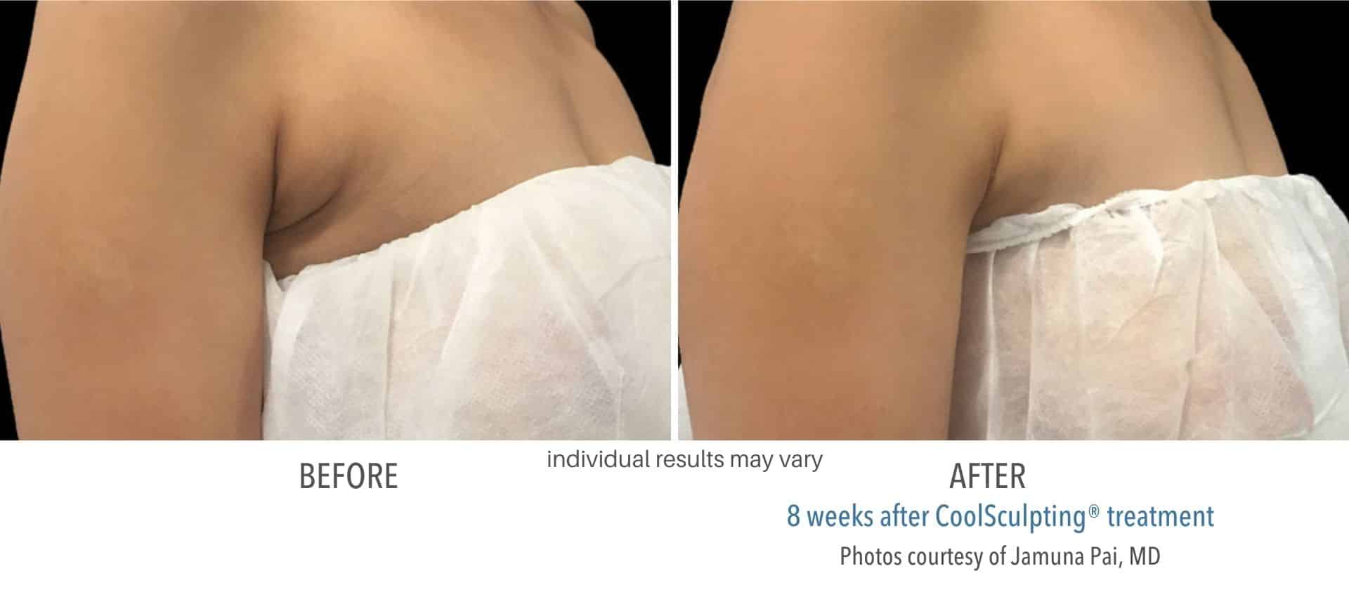 Coolsculpting bra fat before and after results.