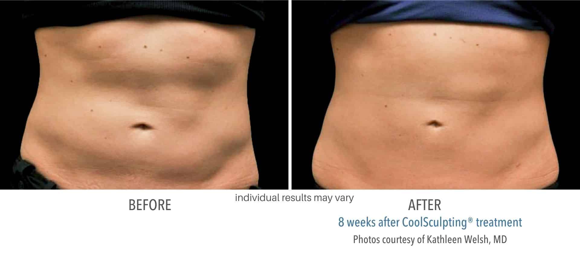 Coolsculpting abdomen before and after results.