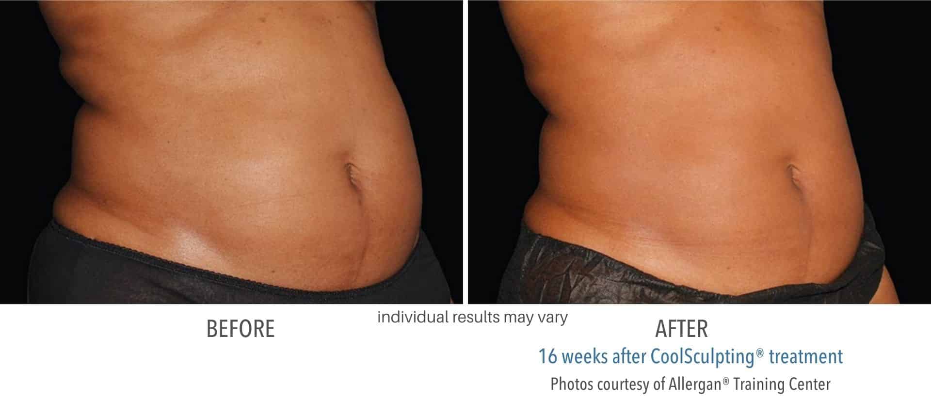 Coolsculpting abdomen before and after results.