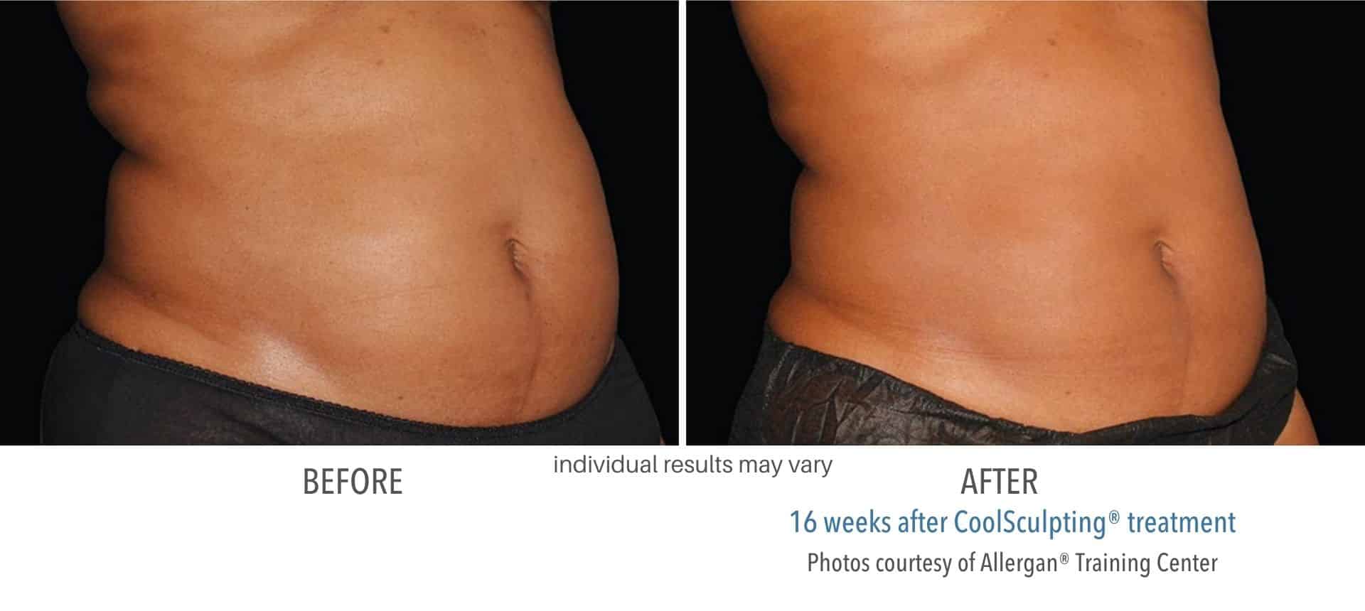 CoolSculpting Rancho Cucamonga, Redlands