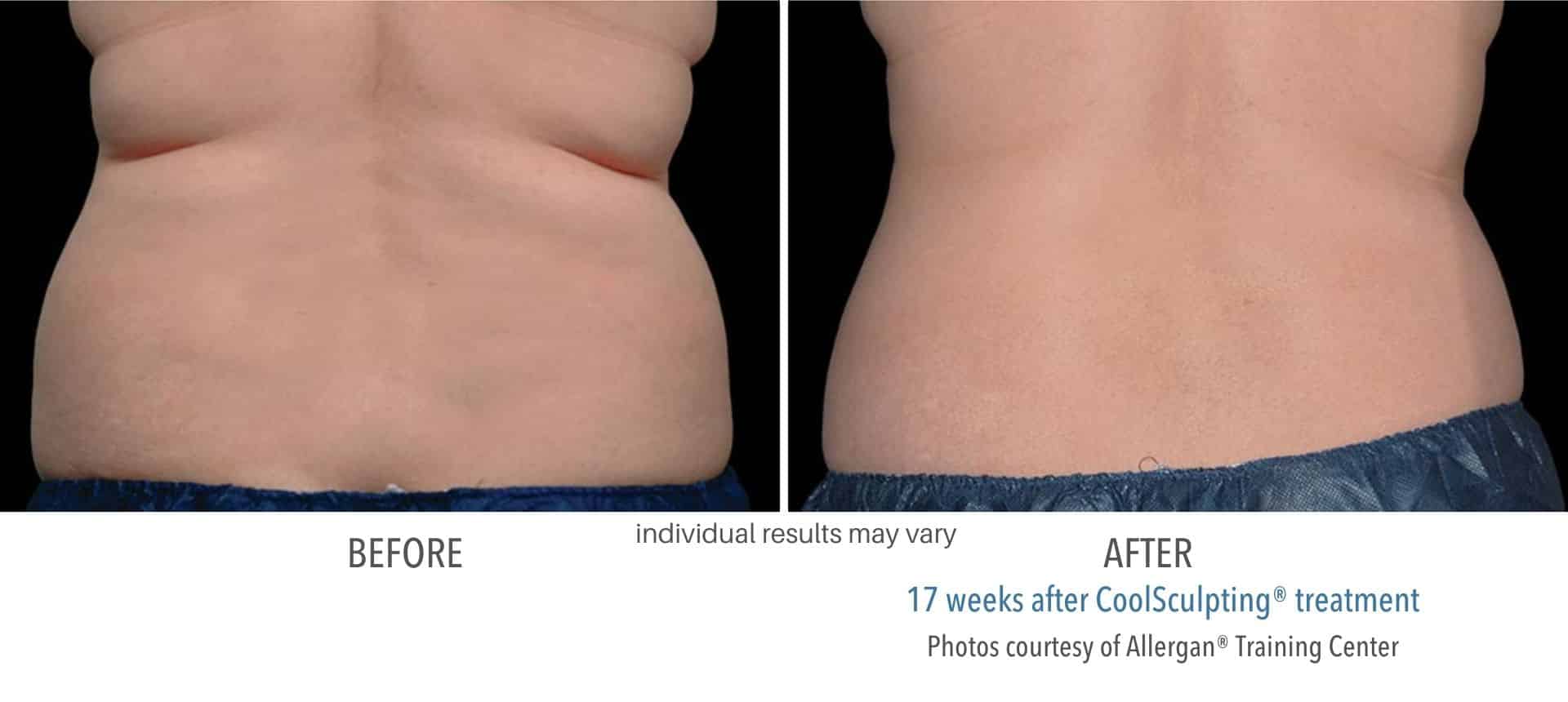 Coolsculpting lower back before and after results.