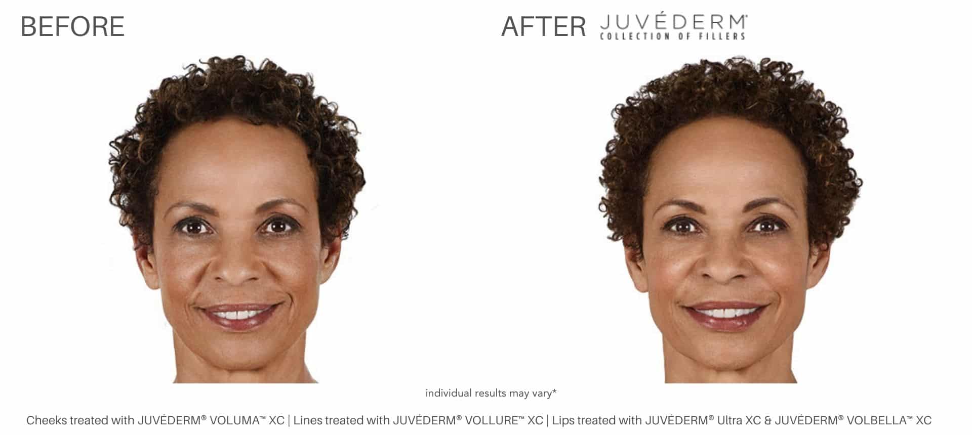 woman's before and after juvderm fillers from health first medical.