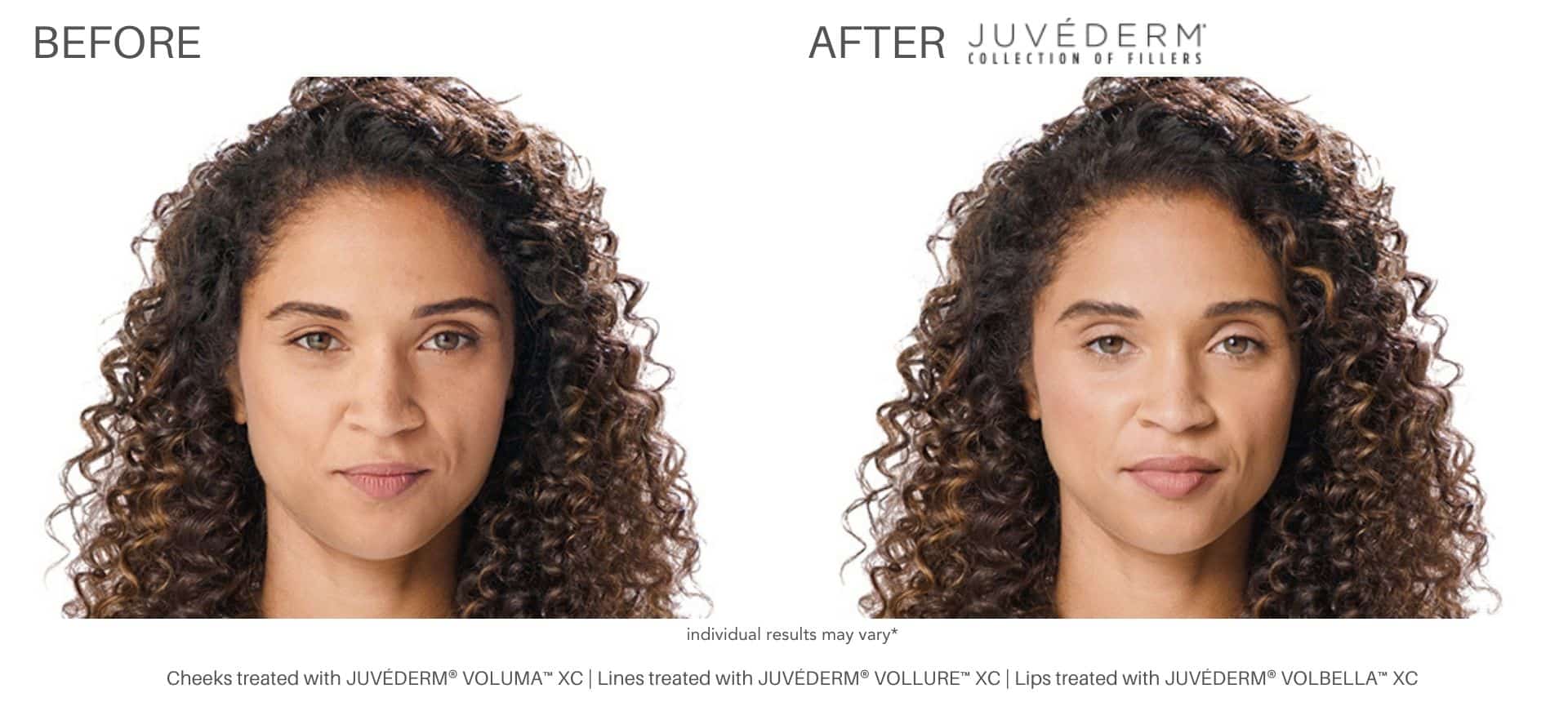 woman's before and after juvderm fillers from health first medical.