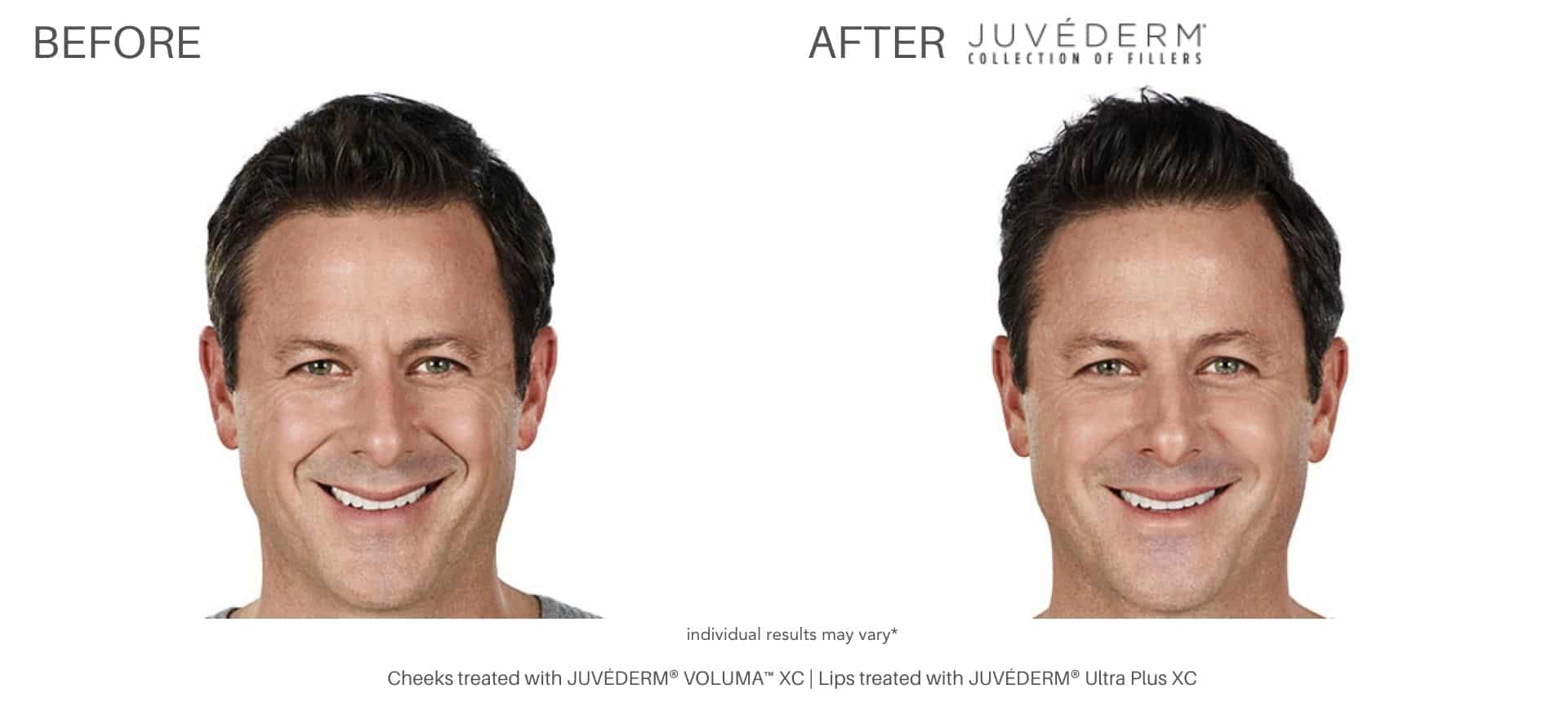 man's juvederm dermal fillers before and after results at health first medical.