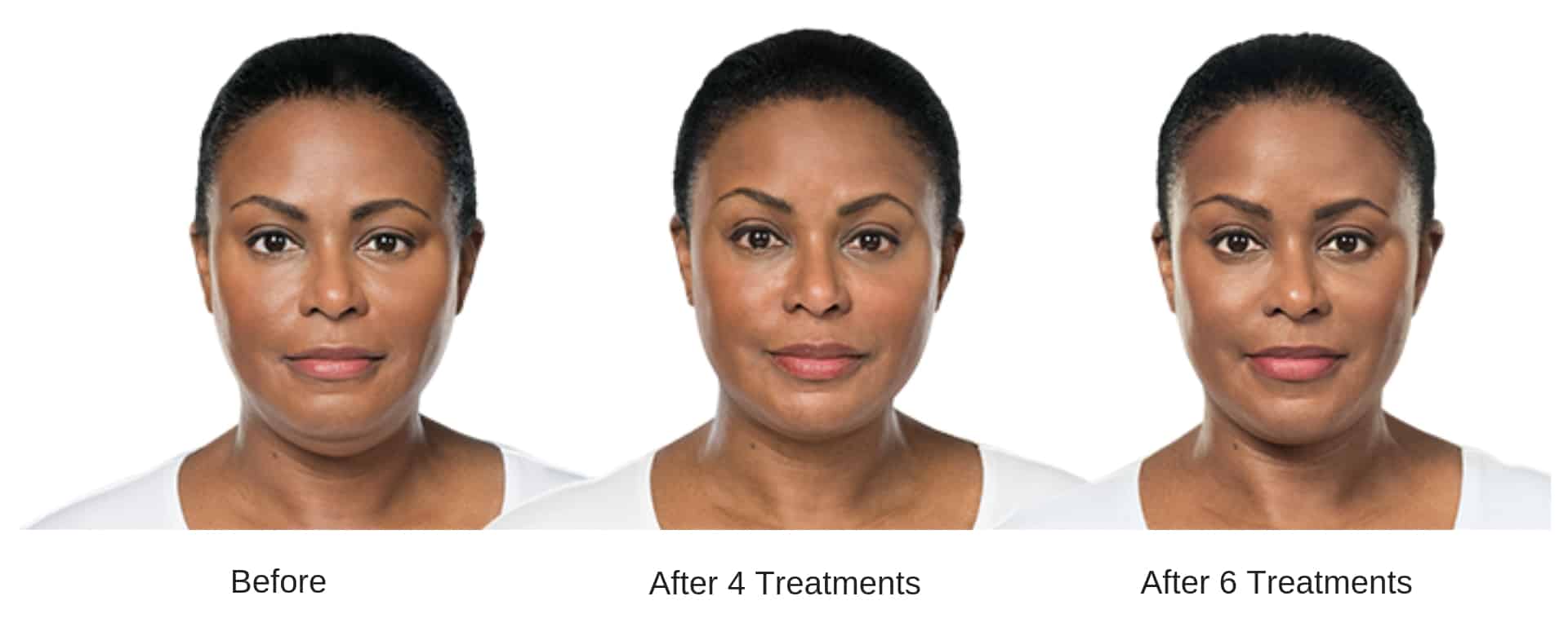 Woman's before and after Kybella treatment results.