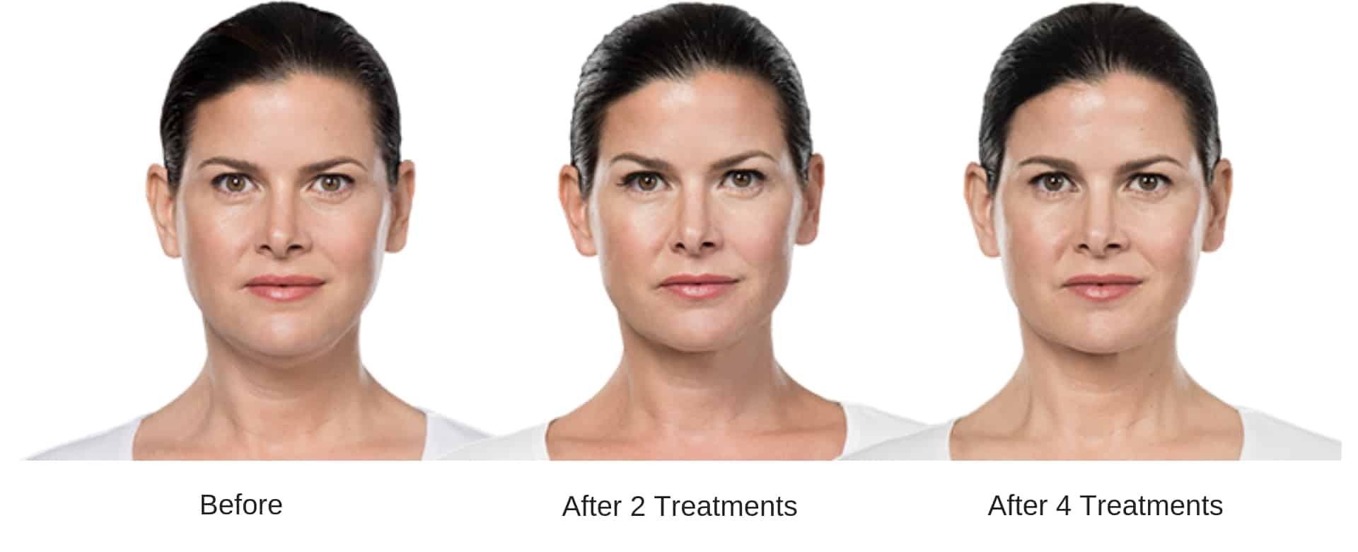 Woman's before and after Kybella treatment results.