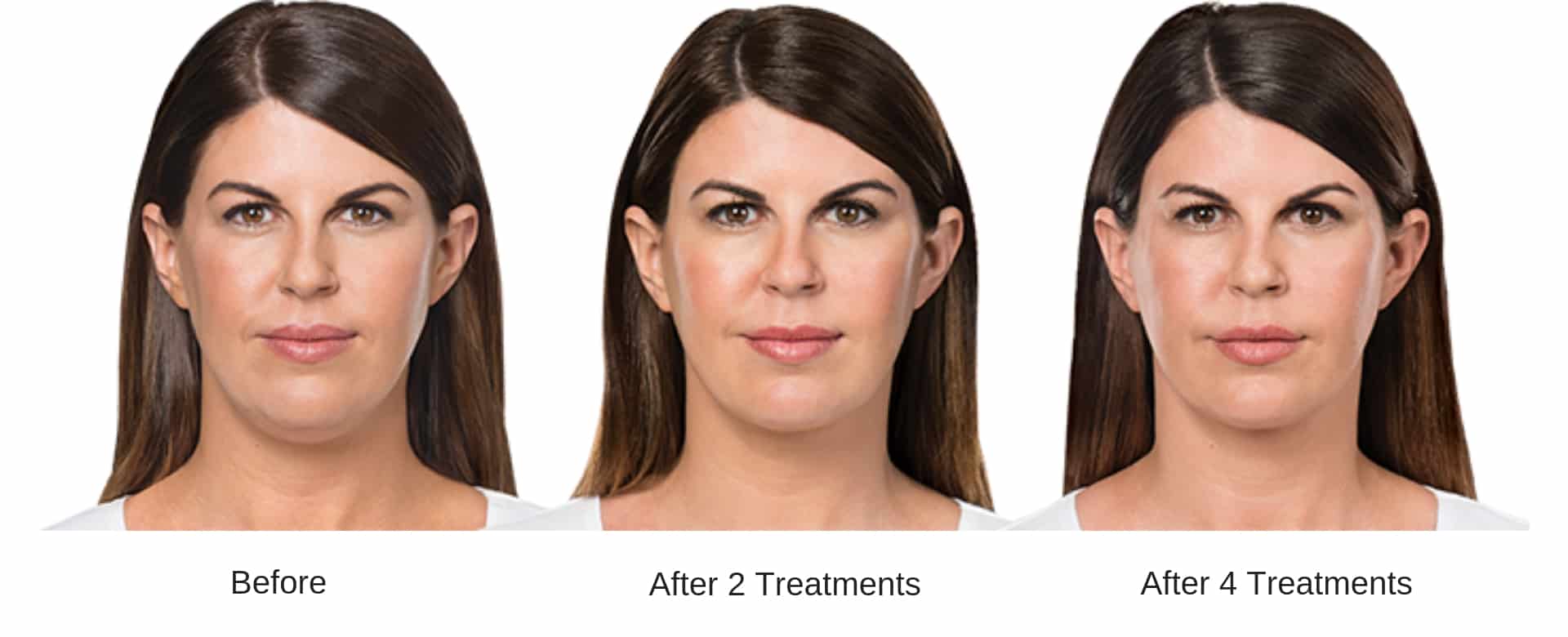 Woman's before and after Kybella treatment results.