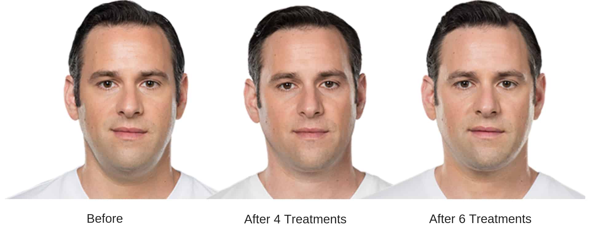 Man's before and after Kybella treatment results.
