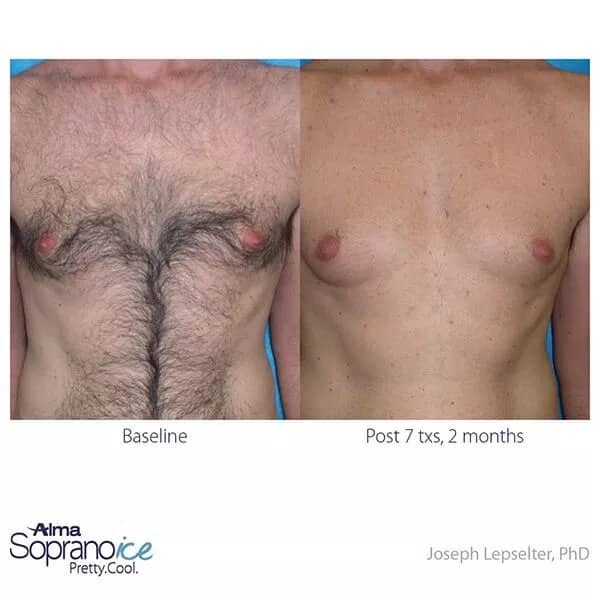 Before and after laser hair removal treatment to the chest.
