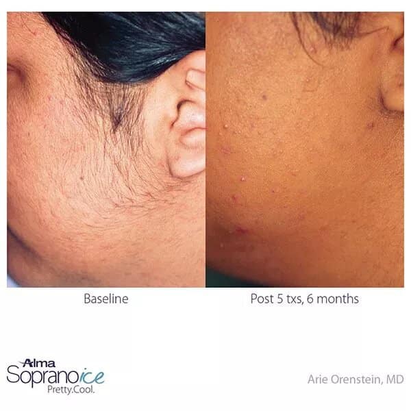Woman's face before and after laser hair removal on the chin.