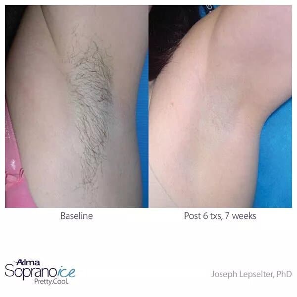Before and after laser hair removal treatment to the armpit.