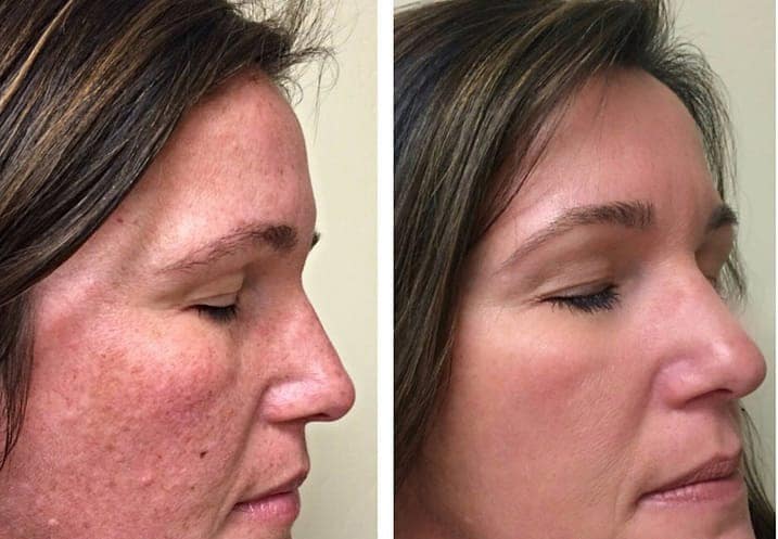 Before and after results showing clear skin after Laser Skin Rejuvenation.