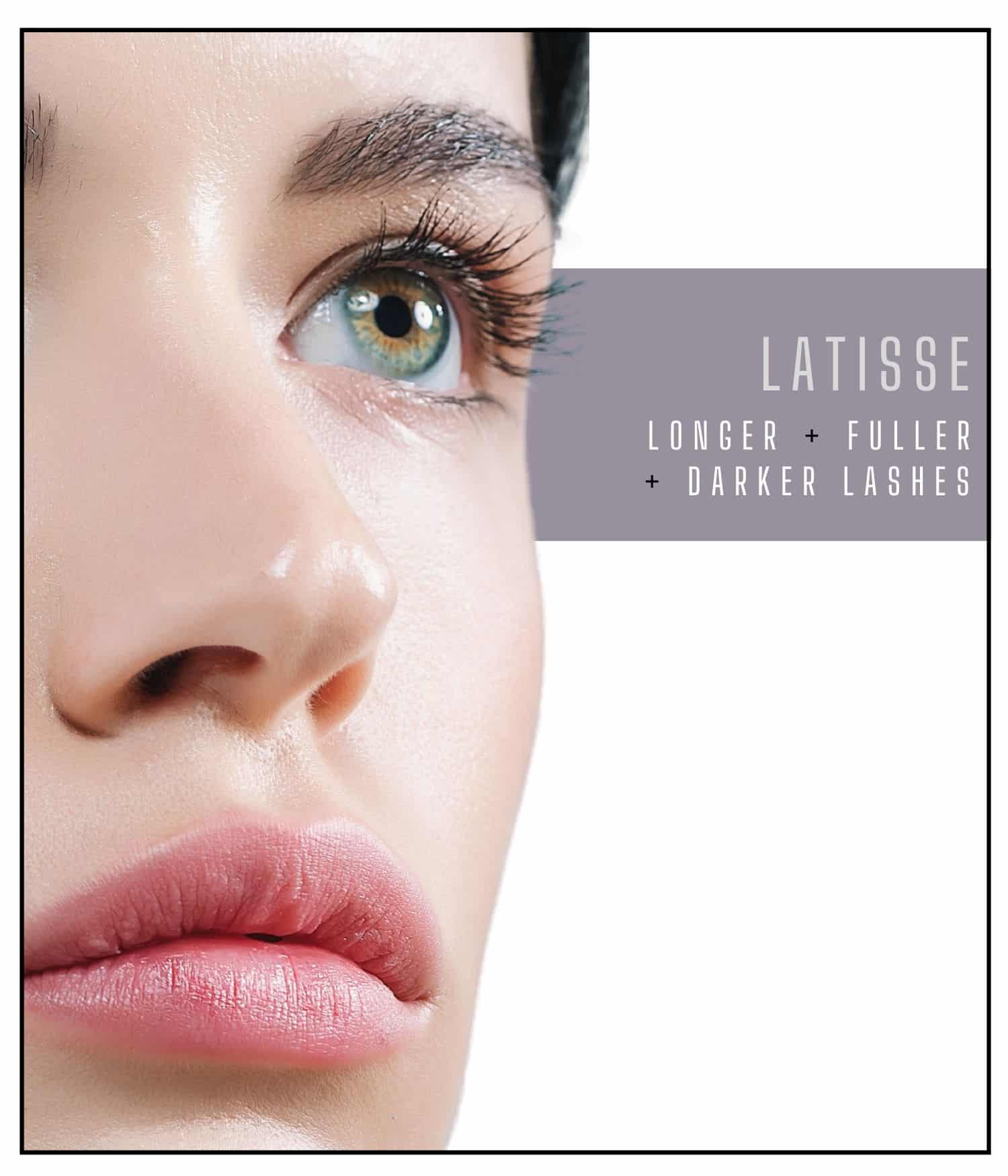 Woman with longer, fuller, and darker lashes from Latisse treatment.