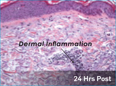 Microscopic view of dermal inflamation.