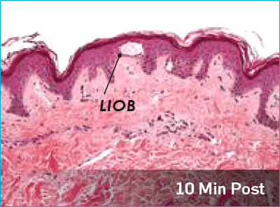 Microscopic view of how PicoSure causes activation in the cells.