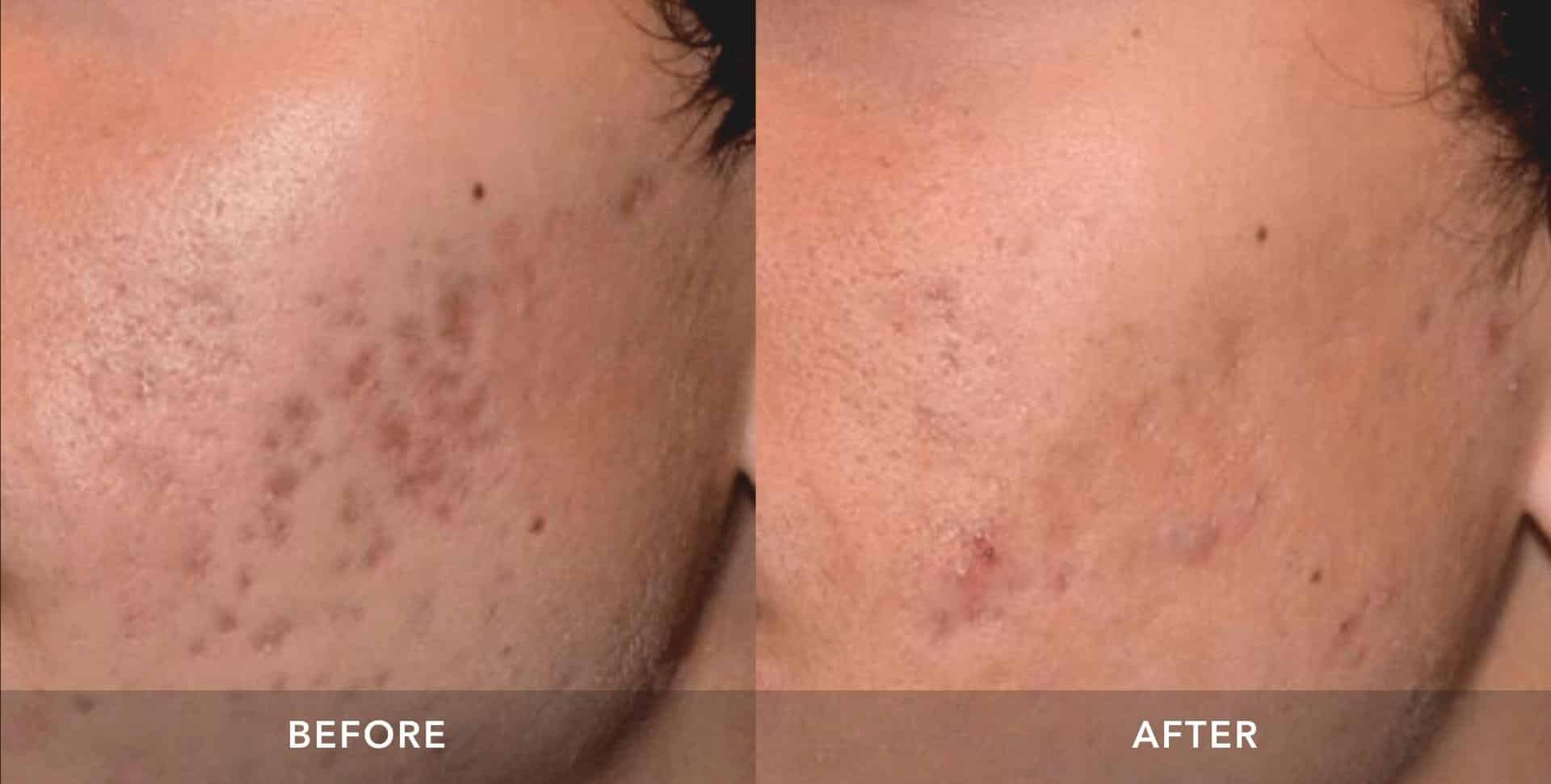 Womans before and after results from picosure skin revitalization.