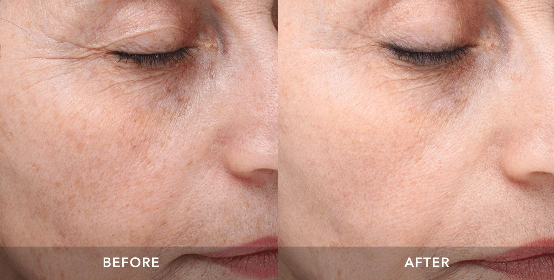 Womans before and after results from picosure skin revitalization.