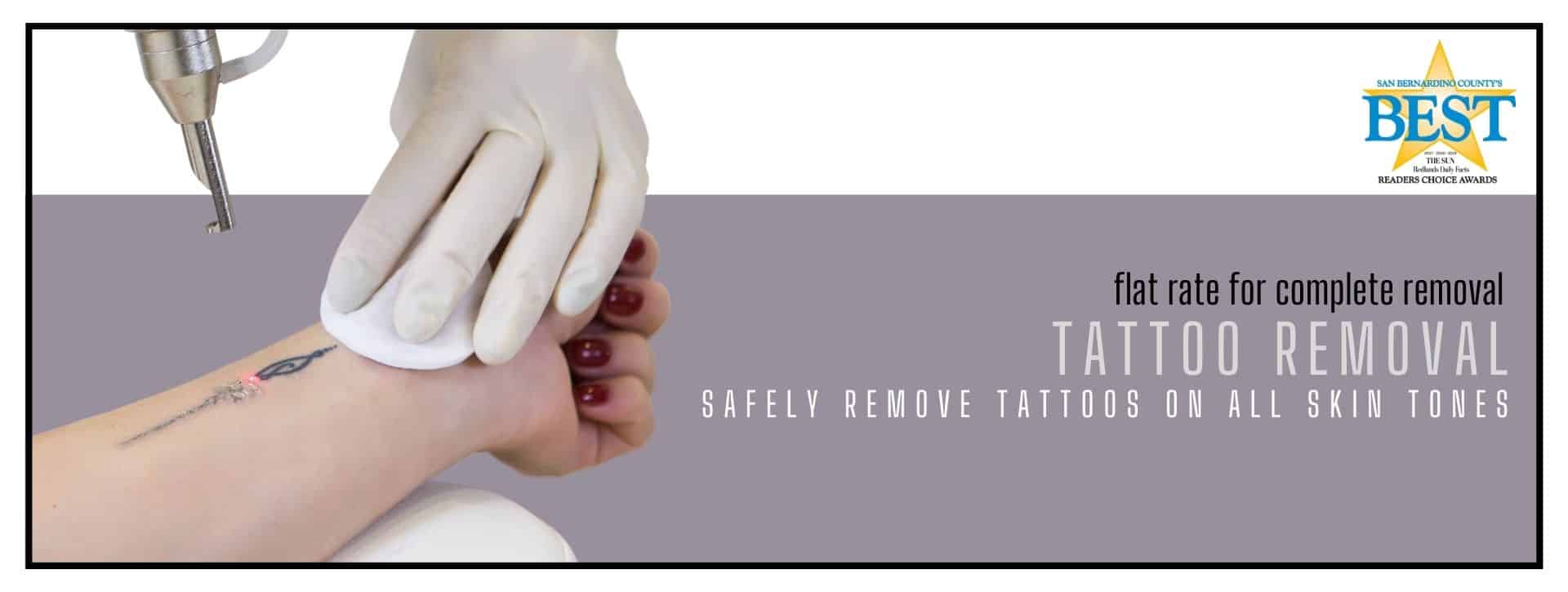 Patient receiving Laser Tattoo Removal.