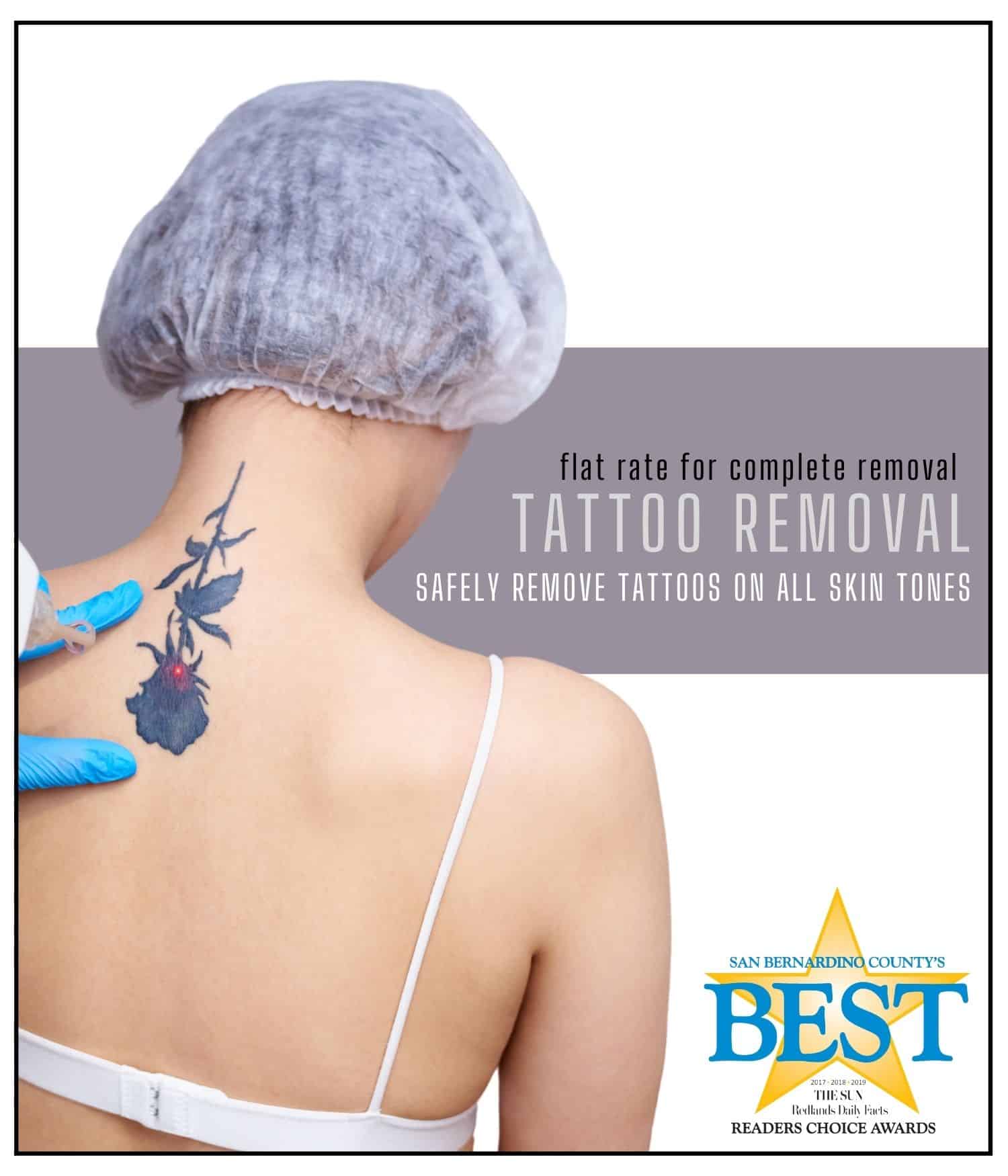 Tattoo Removal Redlands Hesperia CA Health First Weight Loss mobile