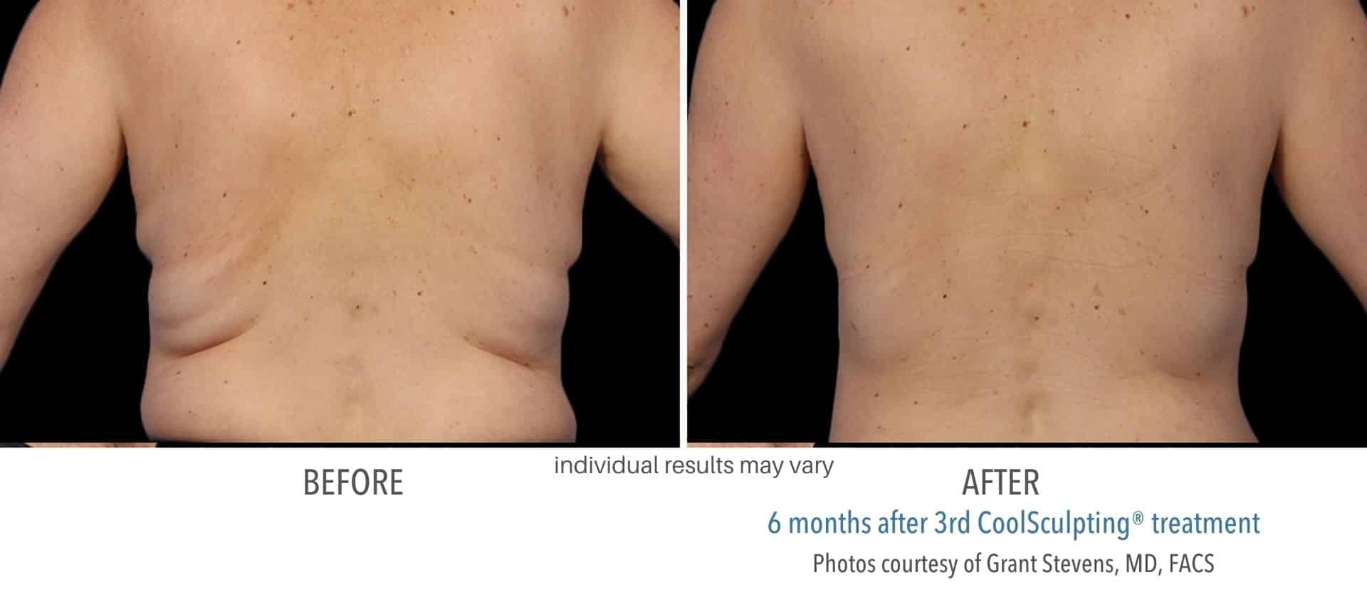 CoolSculpting Before & After Photos - Riverside Medical S.C
