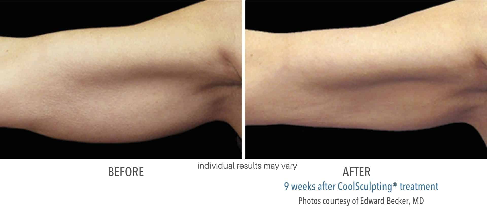 CoolSculpting Elite Before and After - Health First Medical (10)