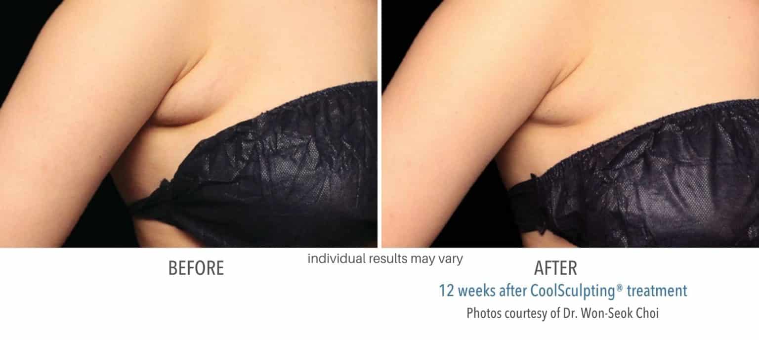 CoolSculpting for Armpit Fat Removal Without Surgery