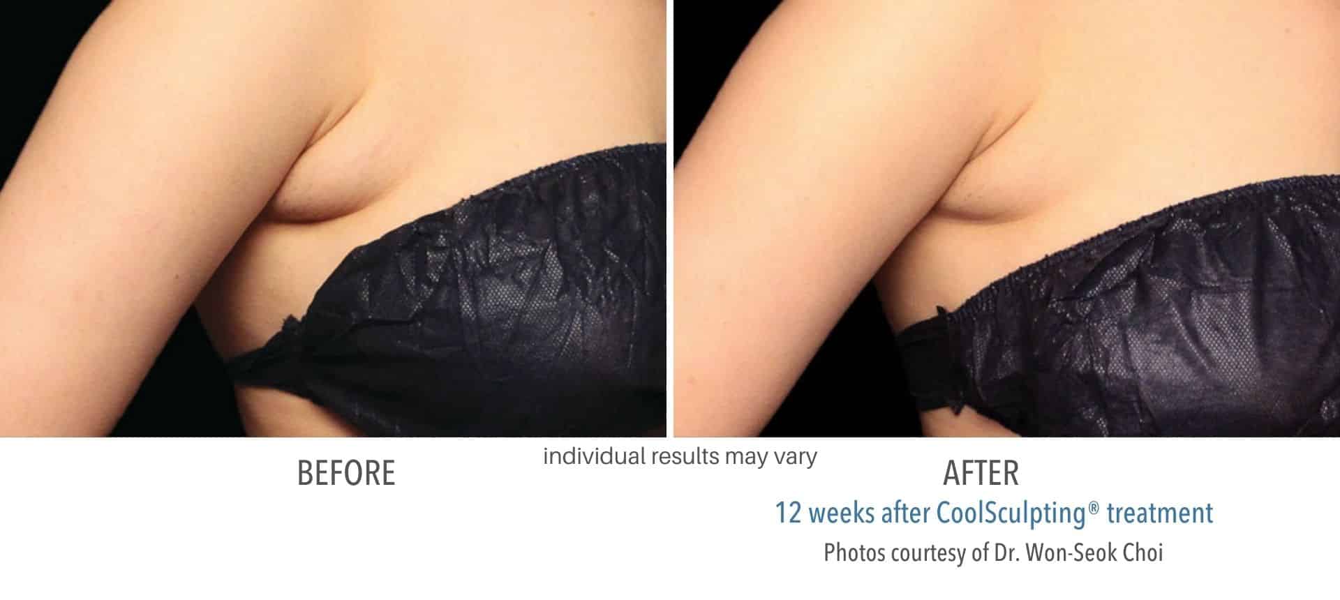 CoolSculpting Elite Before and After - Health First Medical (6)