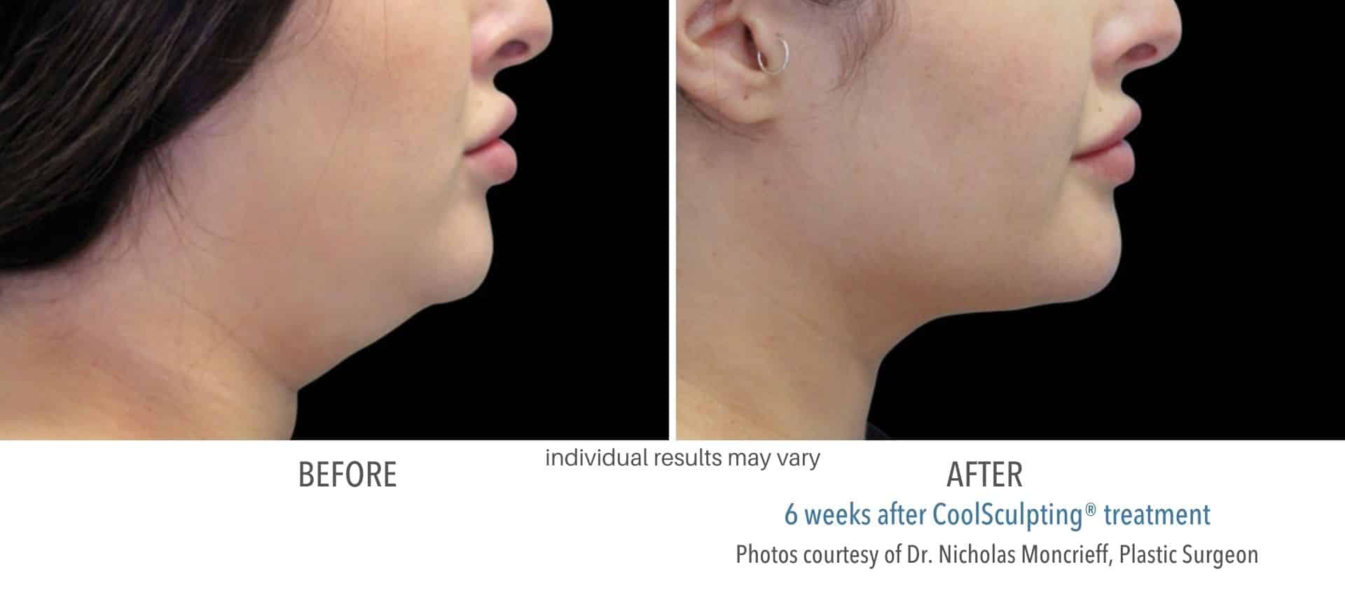 CoolSculpting Elite Before and After - Health First Medical (8)