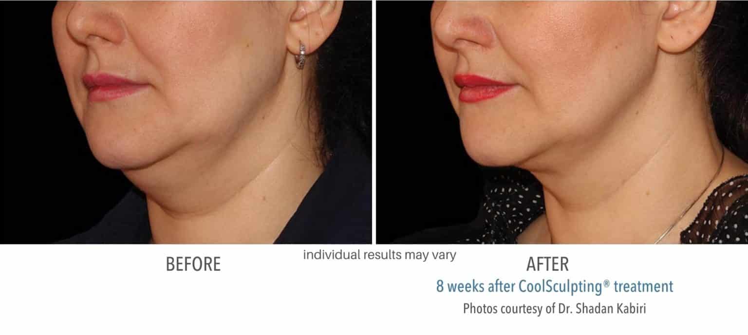 CoolSculpting Elite Before and After 2X the Results in Half the Time
