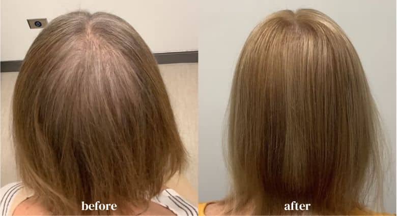 Alma TED Hair Restoration before and after (2)