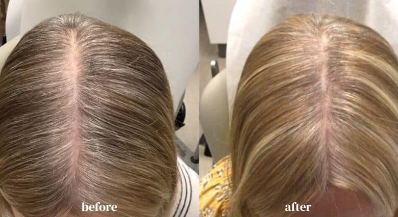 Alma TED Hair Restoration before and after (3)