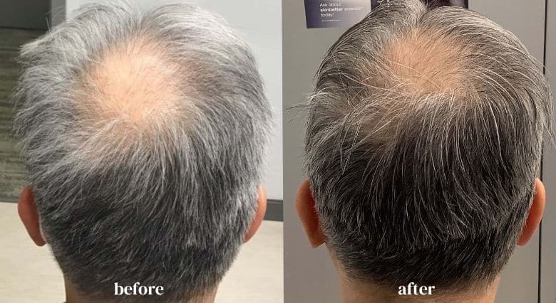 Alma TED Hair Restoration before and after (4)