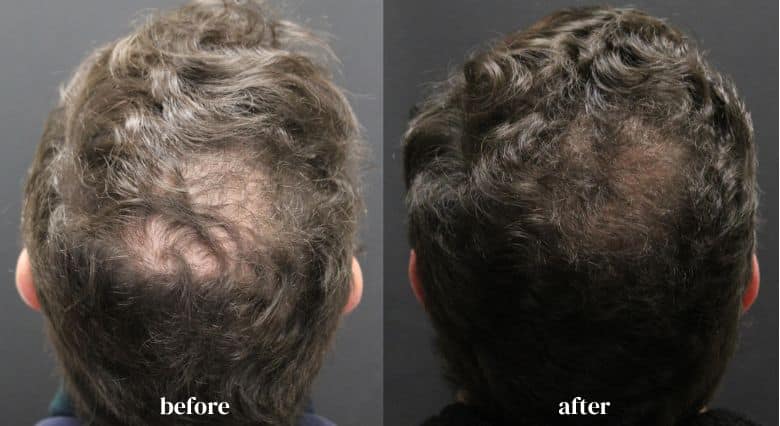 Alma TED Hair Restoration before and after (5)