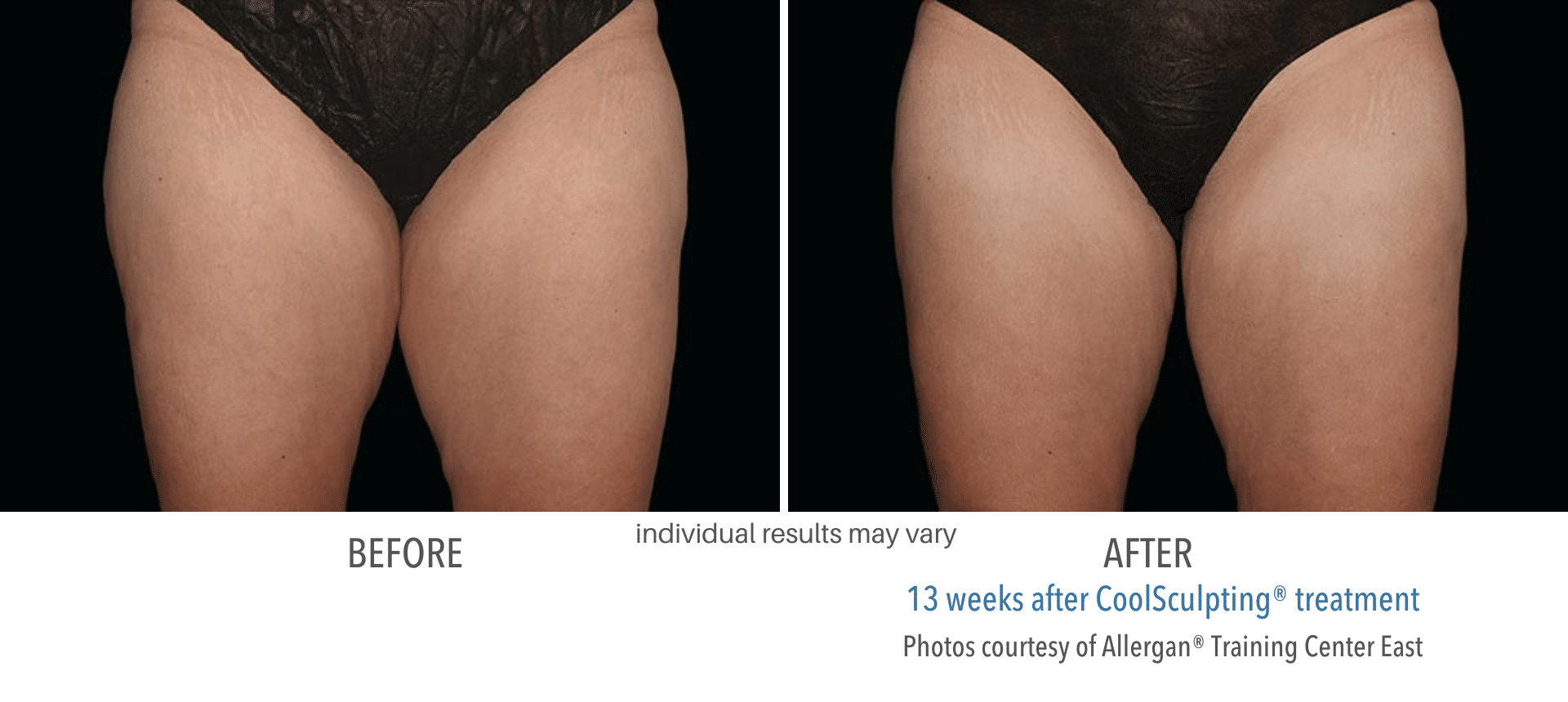coolsculpting thigh before and after treatment