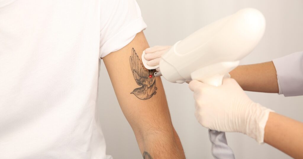 A person wearing a white shirt receiving laser tattoo removal on an upper arm tattoo of a flying bird, performed by a technician wearing gloves and holding a laser device, with a clean white background.
